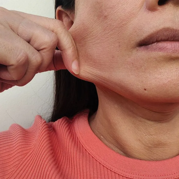 Flacidez facial